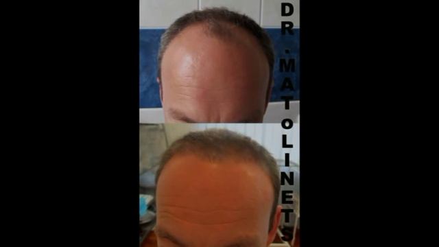 пересадка волос смотреть онлайн