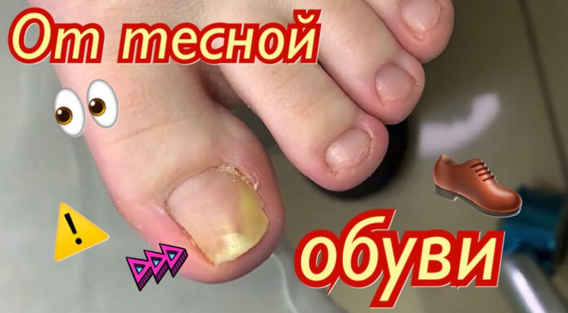 От тесной обуви⚠️????