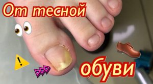 От тесной обуви⚠️????