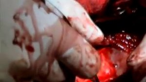 мамаро-коронарное шунтирование.mp4