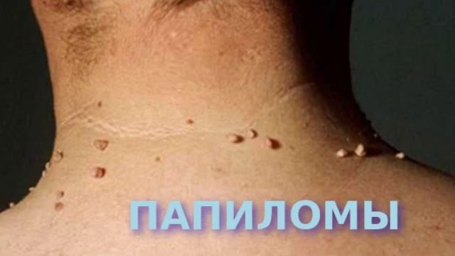 Их не станет! Папилломы - Касторовое Масло успешно удалит ... смотреть онлайн