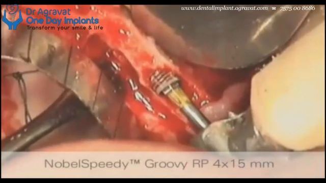 All on 4 Dental Implant Surgery Step by Step Procedure Video Ahmedabad Gujarat India смотреть онлайн