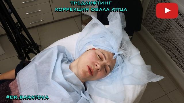 Тредлифтинг как эффективный и максимально атравматичный способ омоложения лица смотреть онлайн