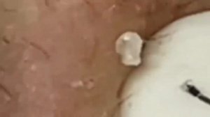 чистка лица от черных точек #10