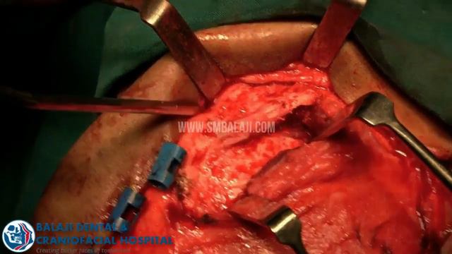 Fibrous Dysplasia of Zygoma and Orbit смотреть онлайн