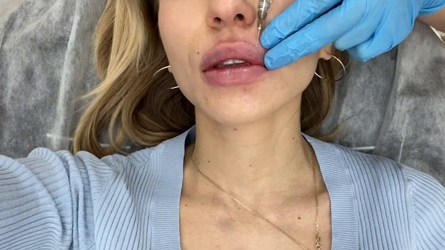 Инъекционное увеличение губ филлером: Мой опыт смотреть онлайн