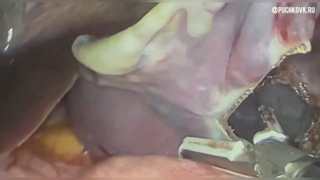 Лапароскопическое иссечение кисты селезенки смотреть онлайн