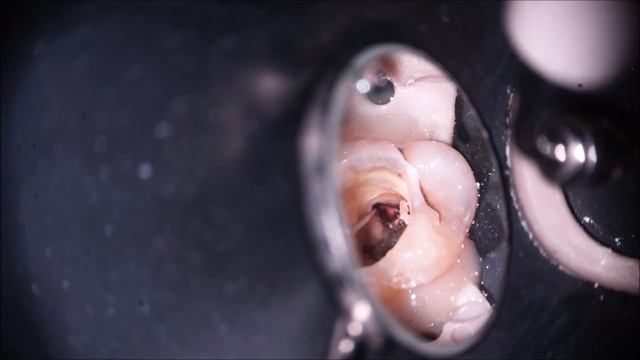 Очистка каналов и обтурация с МТА небного канала. смотреть онлайн