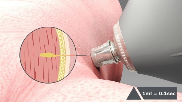 EPIG® – THE FIRST NEEDLE-FREE INTRAMUSCULAR INJECTOR FOR PIGLETS смотреть онлайн