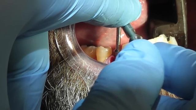Easy Tooth Extraction - Dental Minute with Steven T. Cutbirth, DDS смотреть онлайн