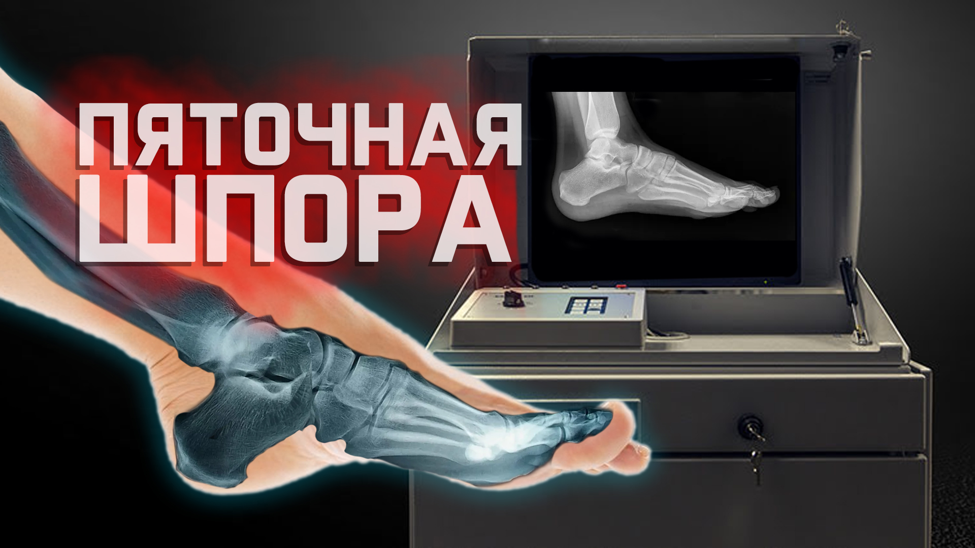 Лечение пяточной шпоры рентгеном! смотреть онлайн