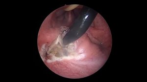 аденоиды у детей