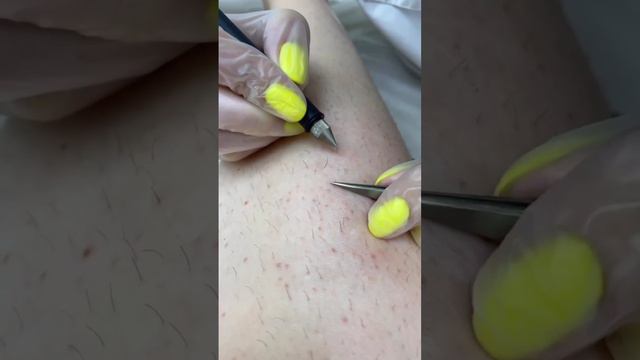 Электроэпиляция в Epil Story 🤍 #лазернаяэпиляция #депиляция #электроэпиляция #косметология смотреть онлайн