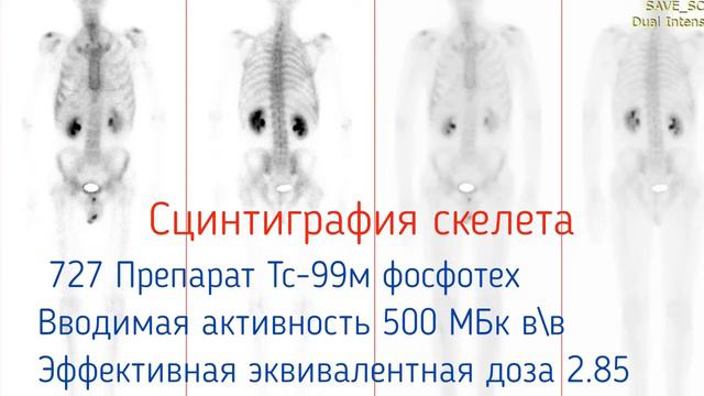 Мезотелиома - рак плевры. Плевропульмонэктомия+гипертермическая химиоперфузия плевры. Скрябин С.А. смотреть онлайн