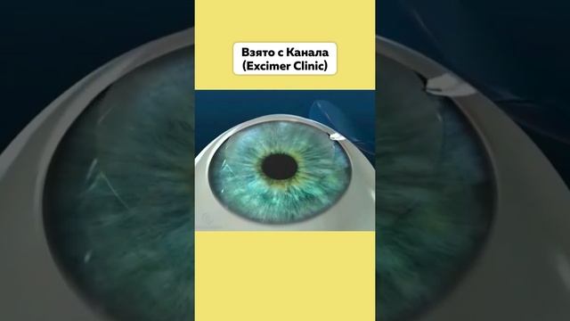 Как Проходит Лазерная Коррекция Зрения ? #КоррекцияЗрения #Зрение #Оперция #Lasik #Коррекция #Глаза смотреть онлайн