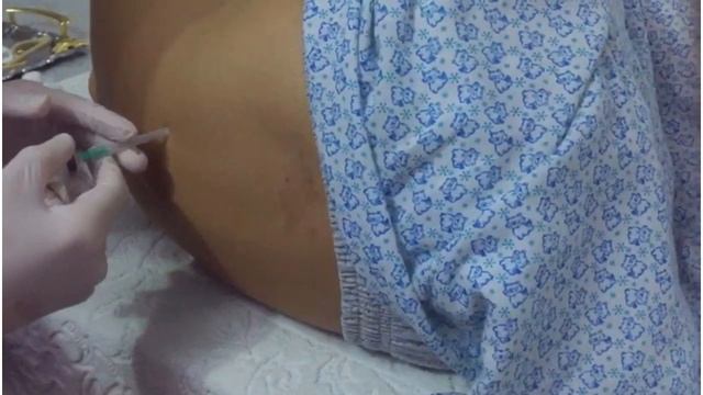 Люмбальная пункция смотреть онлайн