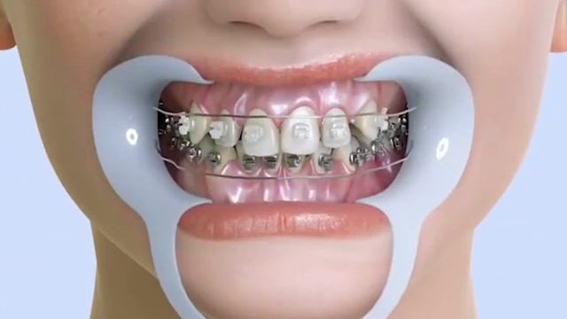 Установка брекетов Diamond Q смотреть онлайн