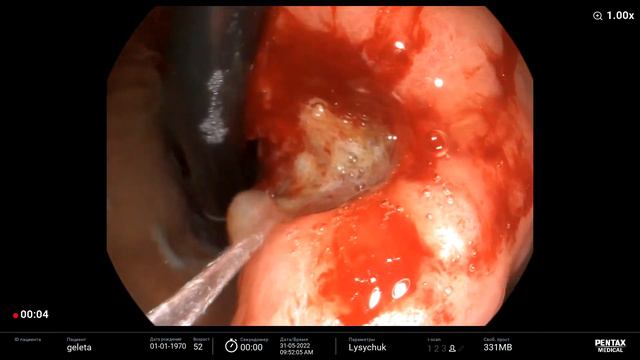 Stomach carcinoma/ Низкодиф.аденокарцинома желудка смотреть онлайн