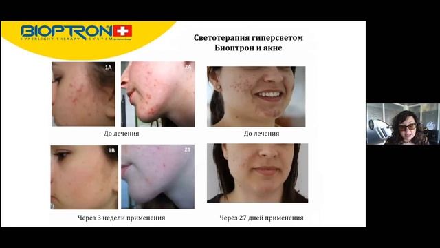 Угревая сыпь - лечение и омоложение смотреть онлайн