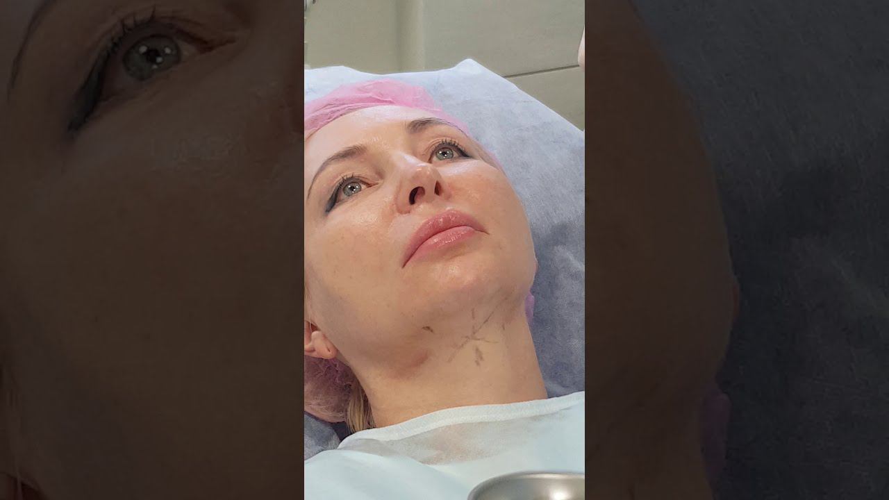 Тредлифтинг за один день смотреть онлайн