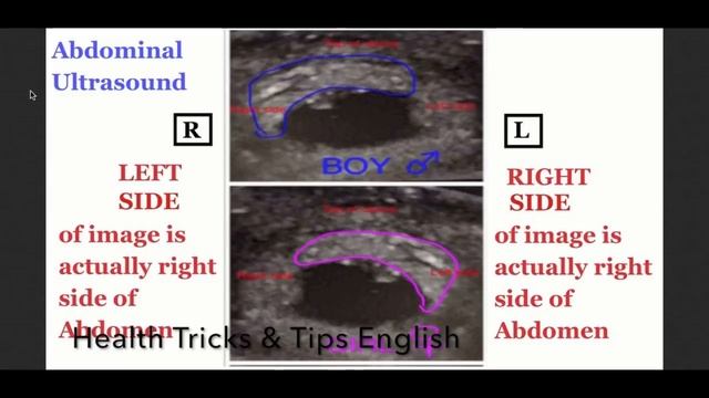 Baby boy symptoms during pregnancy from Ultrasound Report using Ramzi Theory in English смотреть онлайн