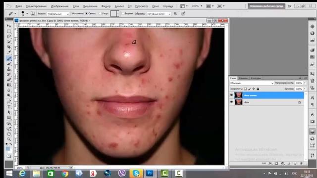 Как быстро избавится от прыщей с помощью фотошопа смотреть онлайн