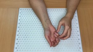 Контрактура Дюпюитрена