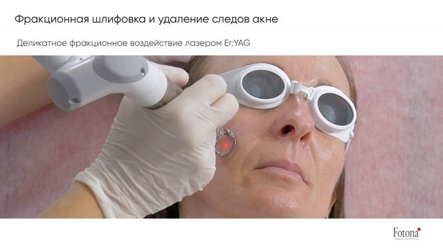 Фракционная абляционная шлифовка и лечение акне с помощью Fotona Dynamis Pro смотреть онлайн