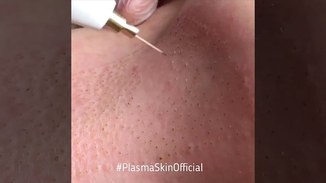 Подтяжка шеи холодной плазмой. PlasmaSkin™️ смотреть онлайн