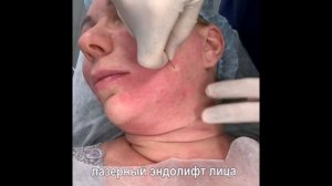 Лазерный Эндолифт лица