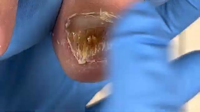 Repair onychomycosis, step by step【Xue Yidao Pedicure】 смотреть онлайн