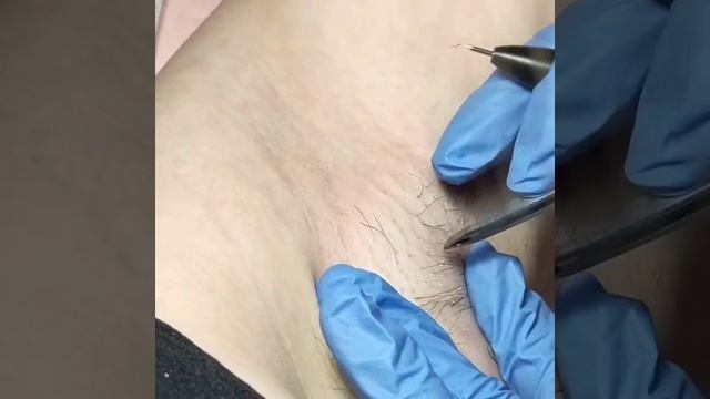 Электроэпиляция подмышечных впадин смотреть онлайн