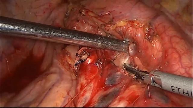 Asvide: VATS non-grasping en bloc mediastinal lymph node dissection (4L, 5L, 6L and 7L) for the ... смотреть онлайн