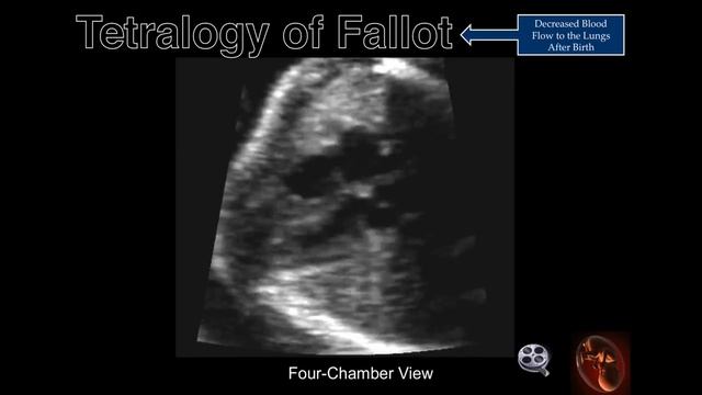 Fetal Echocardiography: Tetralogy Of Fallot