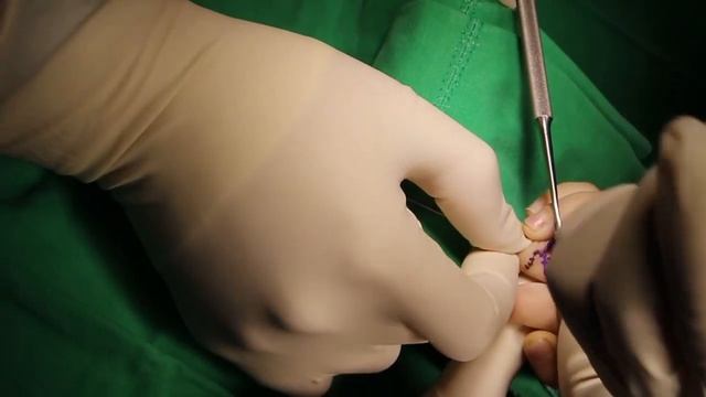 Syndactyly 3rd, 4th finger Rt. Op. Cx. (Rotational deformity) смотреть онлайн