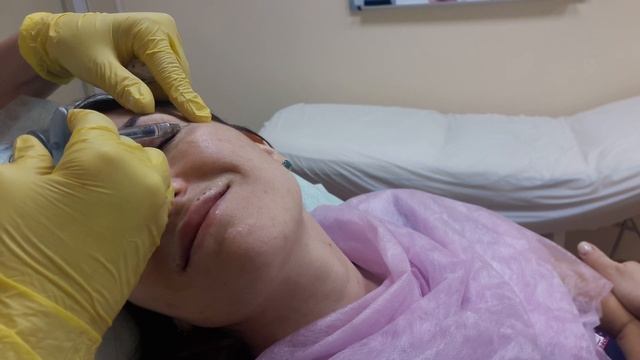 Заполнение морщин филлером Surgiderm 30XP (Франция) смотреть онлайн