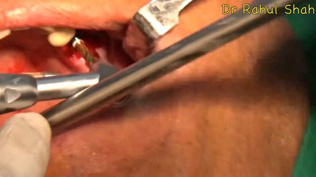 indirect sinus lift смотреть онлайн