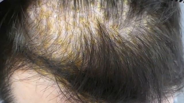 Перхоть: как победить и как предотвратить (Ответы на Вопросы) смотреть онлайн