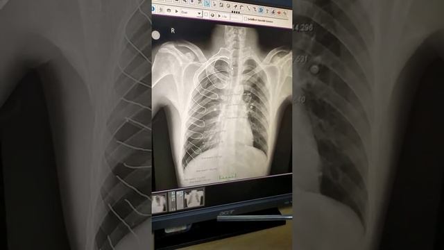 Dr Hilmi Keskin '' Bazal Akciğer Grafi Okuma Bölüm 1 '' смотреть онлайн