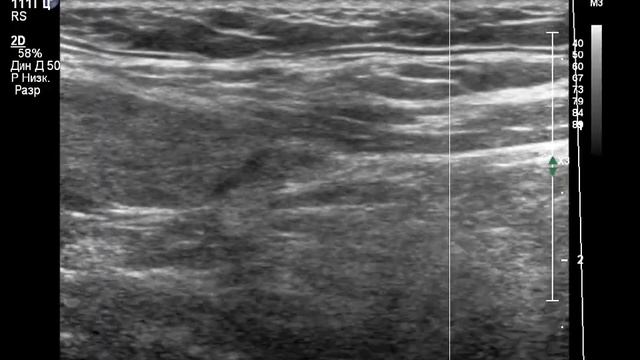 УЗИ щитовидной железы. Вот не люблю такие нечеткие узлы... смотреть онлайн