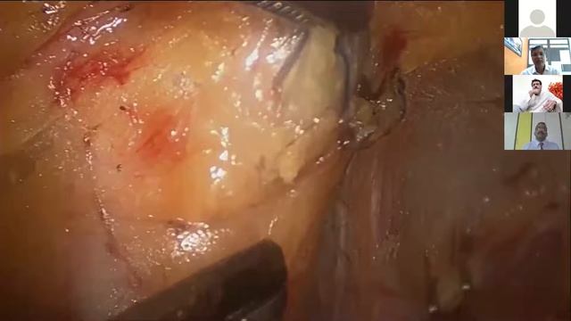 Sentinel Lymph node biopsy смотреть онлайн