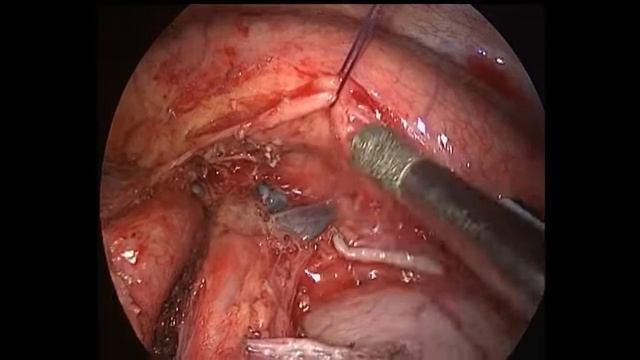 Subcarinal lymph node dessection смотреть онлайн