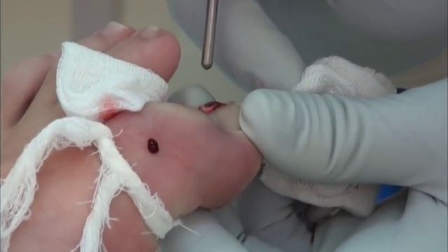 Удаление вросшего ногтя СО2 лазером. смотреть онлайн