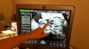 Узи в 20 недель беременности. Определение пола ребенка