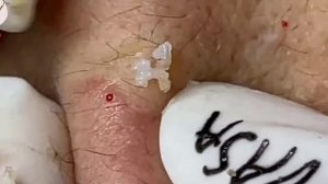 Удаление черных точек 2021