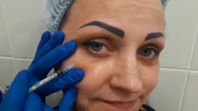 Практика студентки по введению БОТУЛОТОКСИНА в верх. часть лица под руководством Андреевой Н.В.