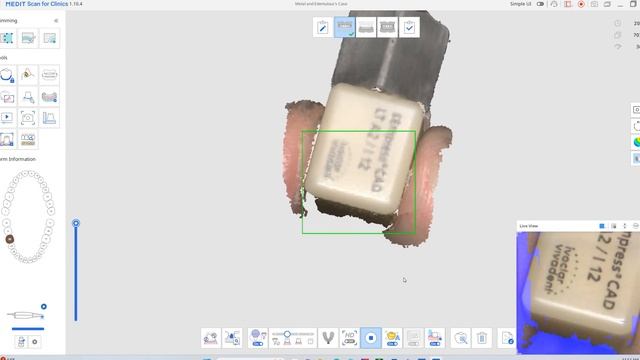 Metal and Edentulous Scanning - Medit i700 смотреть онлайн