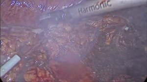 Удаление почки