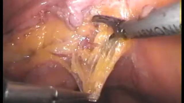Laparoscopic hysterectomy with pelvic lymph node dissection Part 2 by Dr. Serg Baydo смотреть онлайн