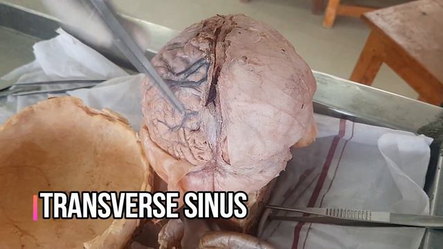 Dural folds and Dural venous sinuses - Gross Anatomy ( Dissection ) смотреть онлайн